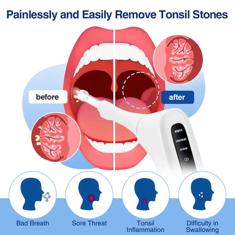 Electric Vacuum Tonsil Stone Removal Tool Kit 3-Level Suction Tonsil Cleaner Tonsil Stone Extractor for Oral Fresh Care